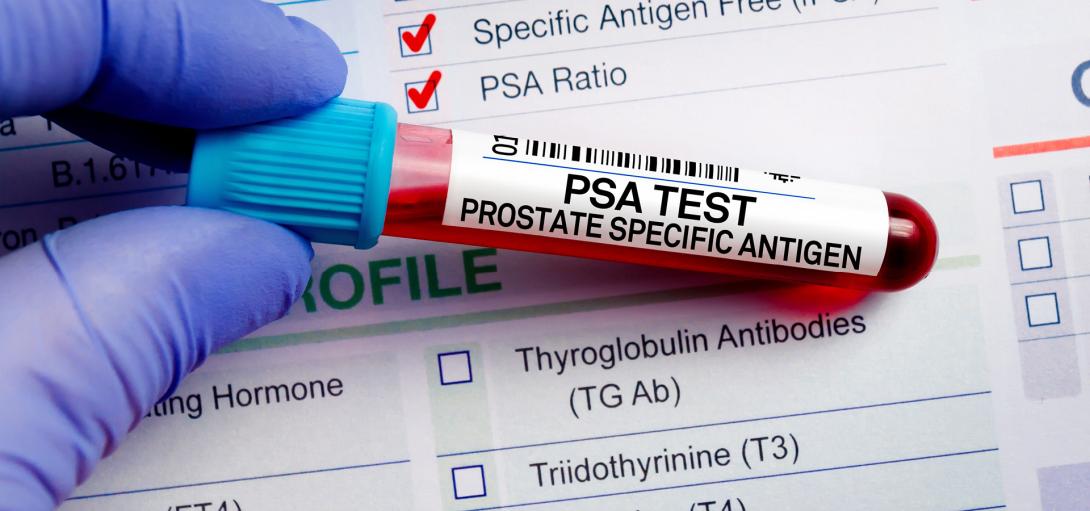 Test tube with prostate specific antigen test sample